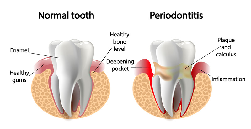 healthy and unhealthy teeth periodontics