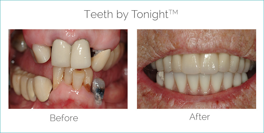 teeth by tonight before and after philadelphia pa area