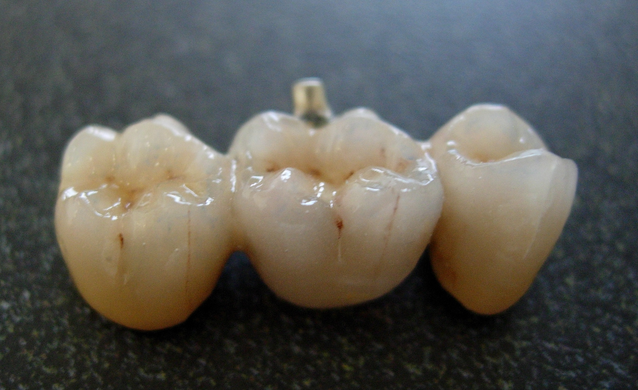 bridge after dental porcelain restoration