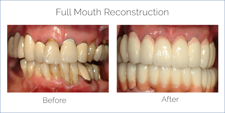 full mouth reconstruction before and after