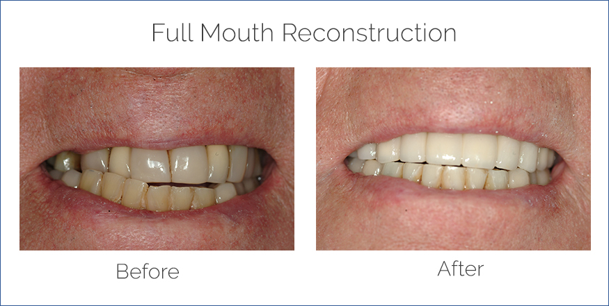 full mouth reconstruction before and after