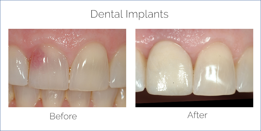 Dental Implants before after