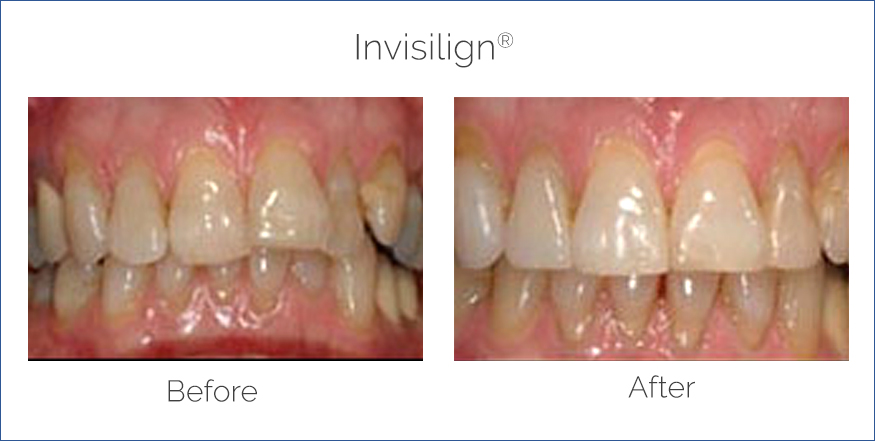 before and after invisalign