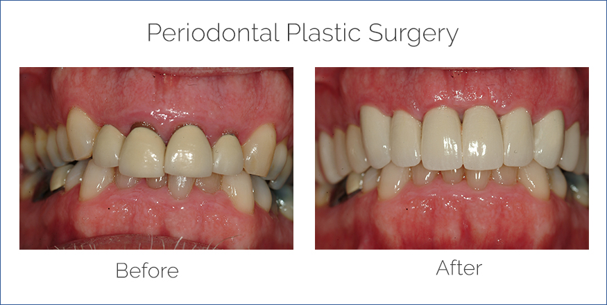 periodontal plastic surgery before and after