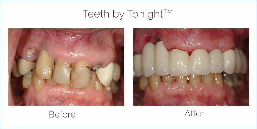 teeth by tonight before and after