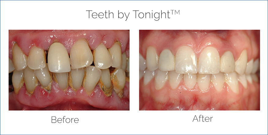 teeth in a day before and after