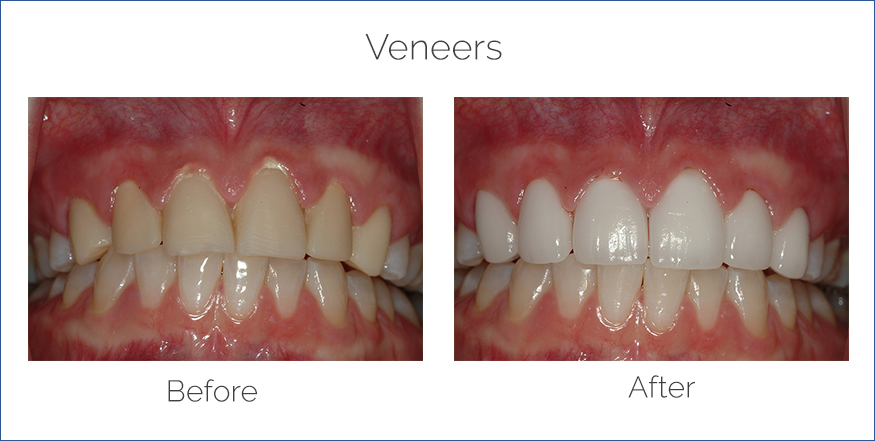 dental veneers before and after