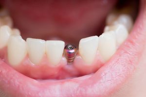 mini dental implants
